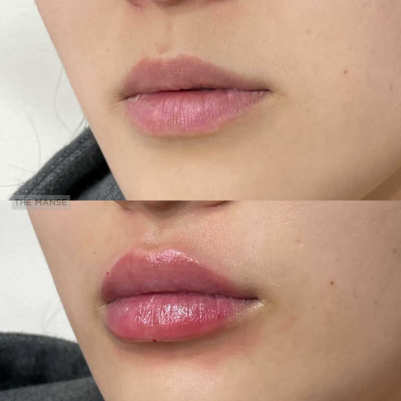Lip filler