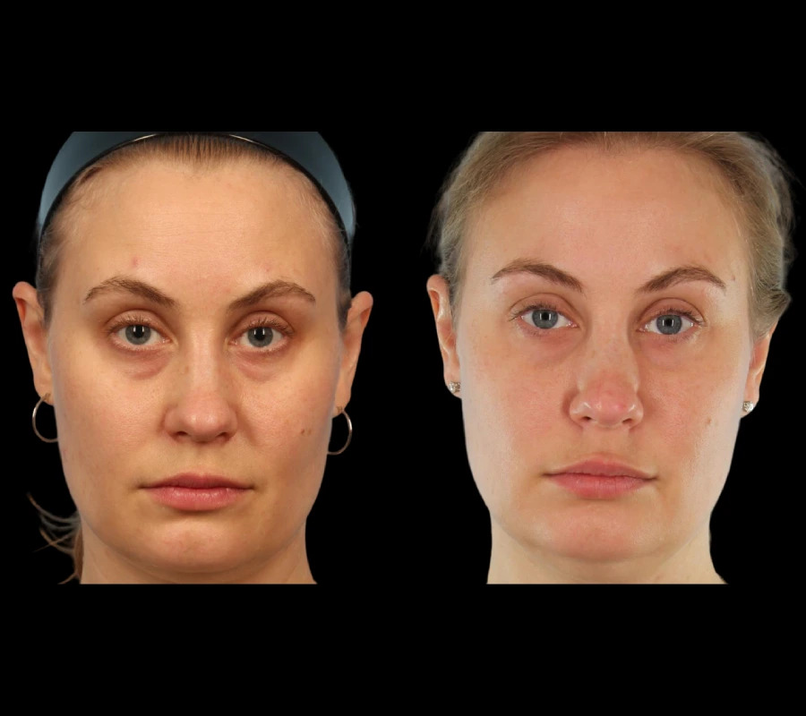 Under Eye Fillers Treatments in Dubai