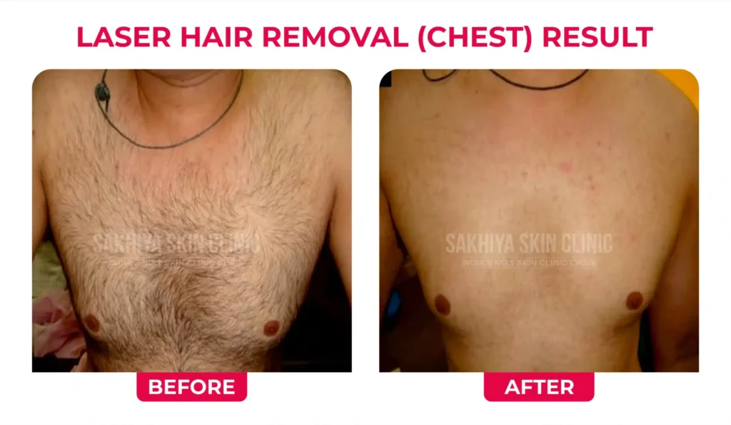 laser hair removal