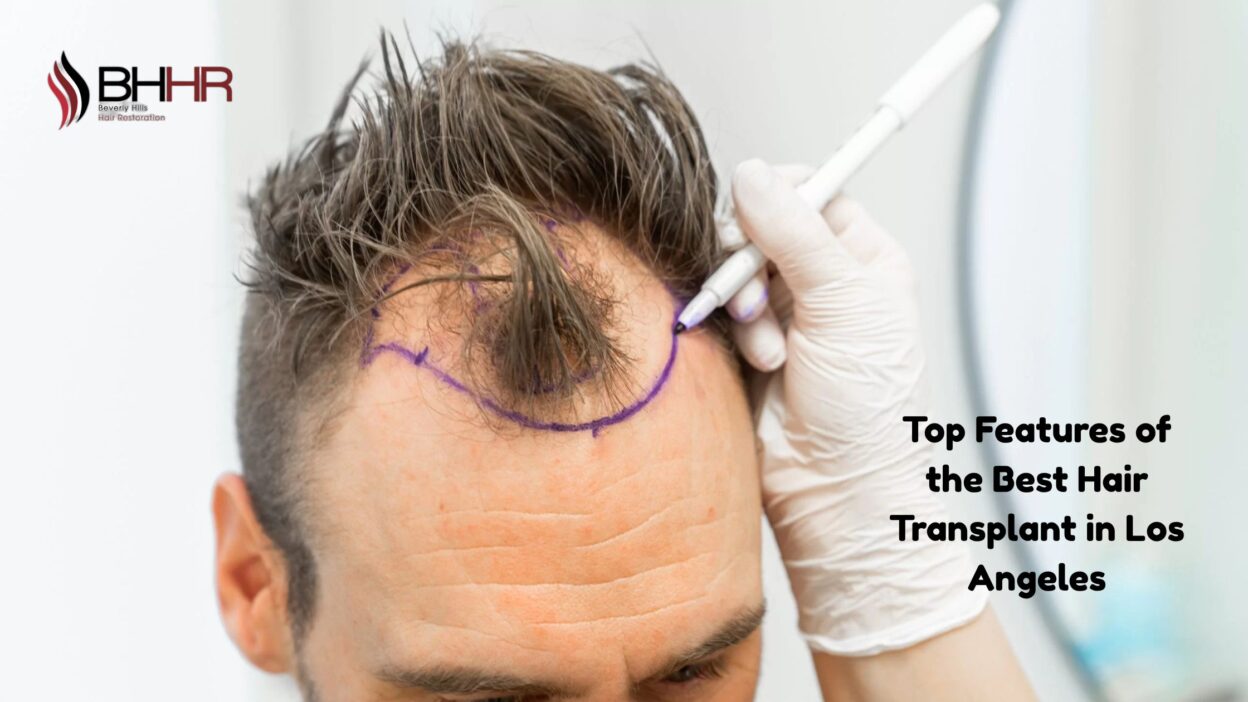 best hair transplant in los angeles