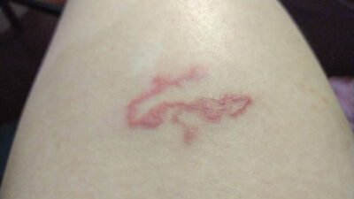 Signs of Parasites in Humans