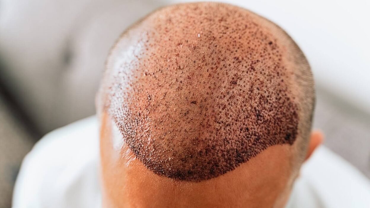 How Many Hair Grafts Are Needed For Hair Transplant?