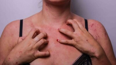 acne on breast