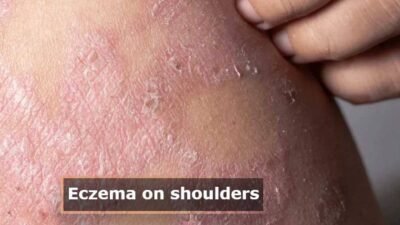 eczema on the shoulder