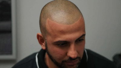 How Scalp Micropigmentation Improves Appearance