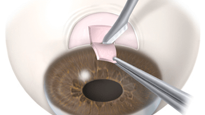 Early Detection & Expert Care at the Best Glaucoma Hospital in Ropar – Pannu Eye Hospital