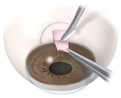 Early Detection & Expert Care at the Best Glaucoma Hospital in Ropar – Pannu Eye Hospital