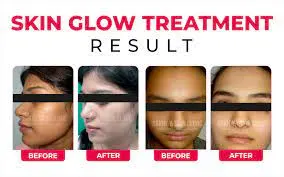 Skin Glow Treatment